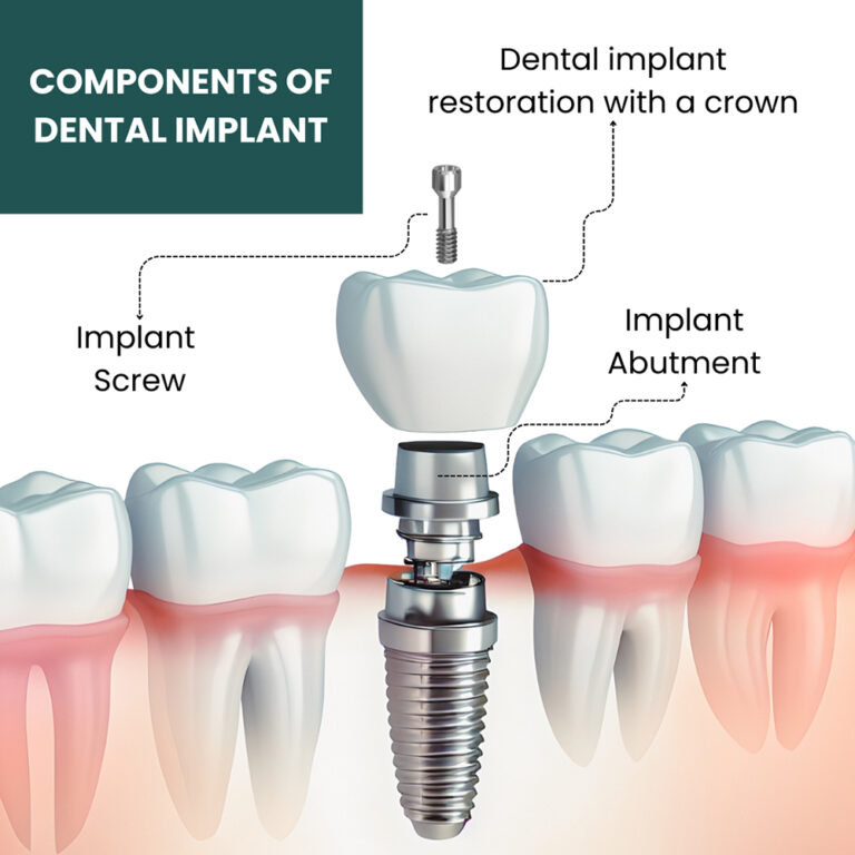 Dental Implants