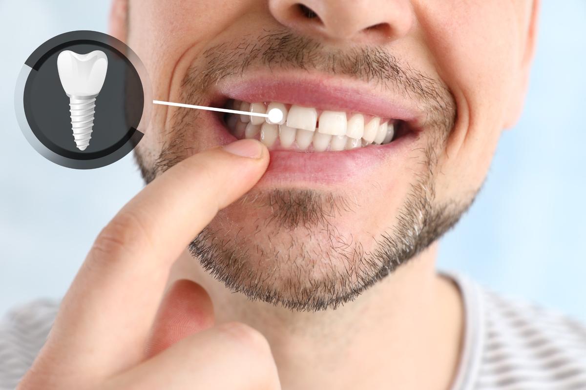 dental implants Los Angeles